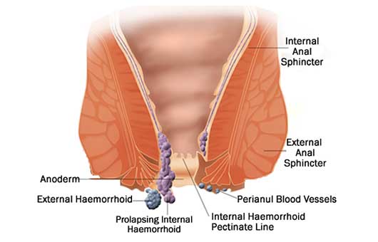 Haemorrhoids diagram